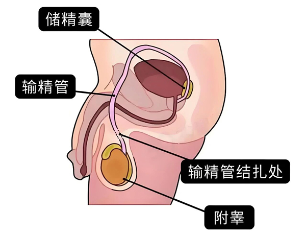 男性結(jié)扎.jpg
